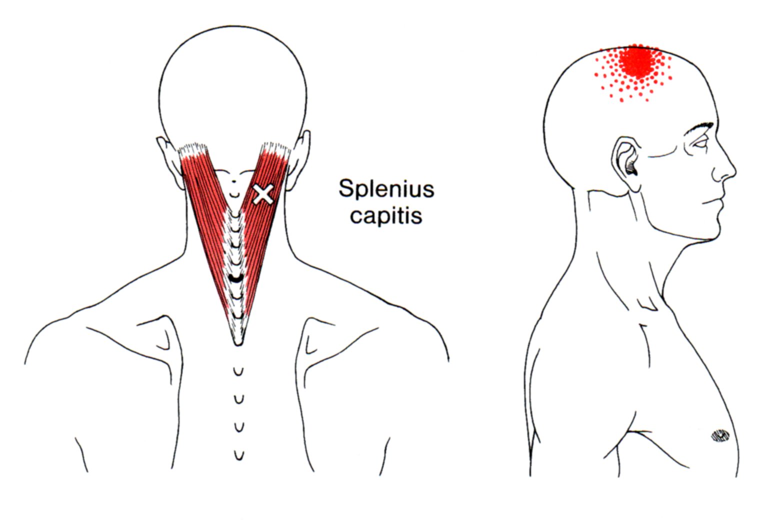 Splenius capitis the trigger point referred pain guide